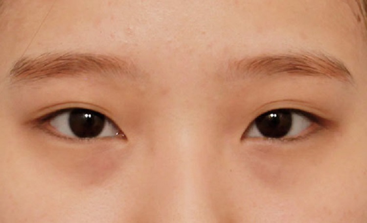 Triple Crease Eyelid